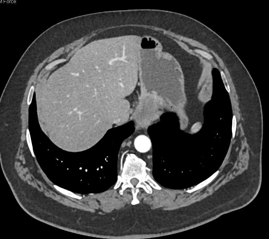 Carcinoma in Gastric Fundus - CTisus CT Scan