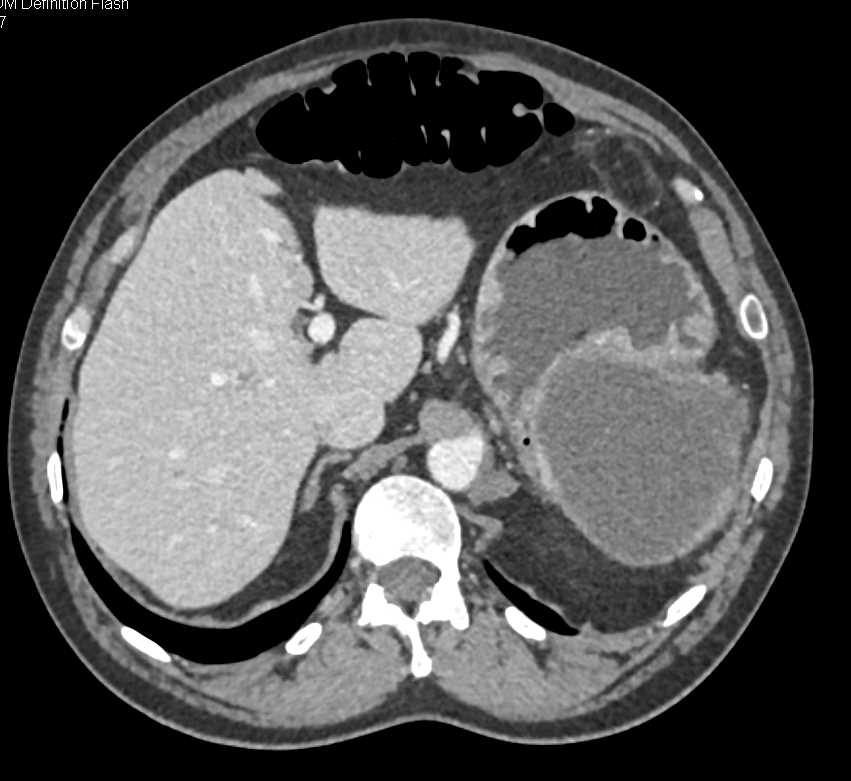 Gastric GIST Tumor - CTisus CT Scan