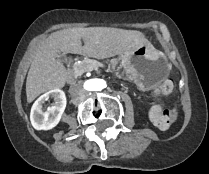 Ulcerating Gastric Adenocarcinoma with Bulky Adenopathy - CTisus CT Scan