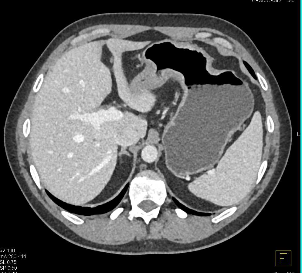 Carcinoma of the Gastric Antrum - CTisus CT Scan