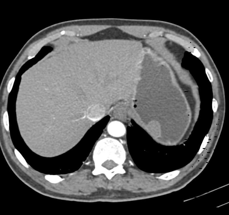 Gastric GIST Tumor - CTisus CT Scan
