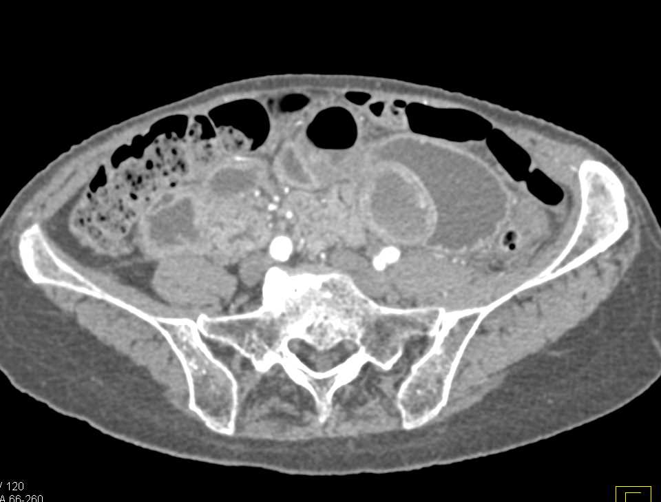 Gastric GIST Tumor - CTisus CT Scan