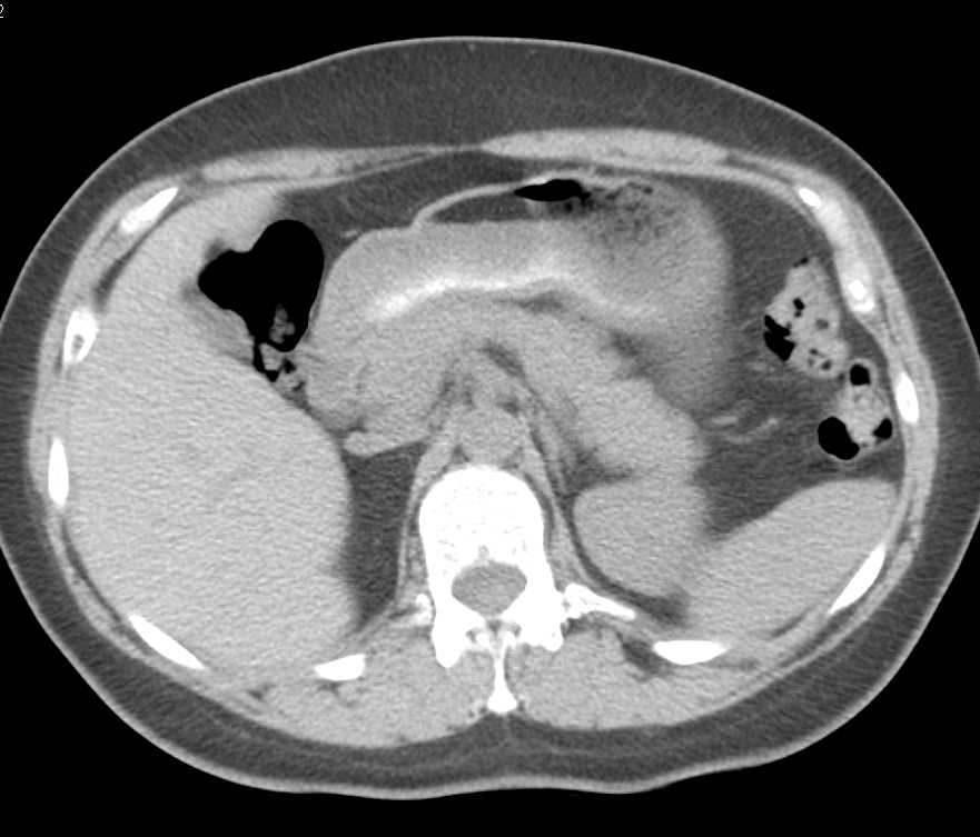 Patient was Ingesting Mineral Oil. See fat fluid level in the Stomach - CTisus CT Scan