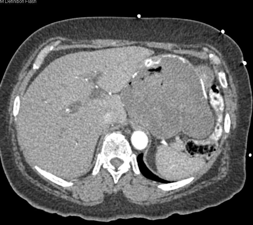 Cystogastrostomy Tube - CTisus CT Scan
