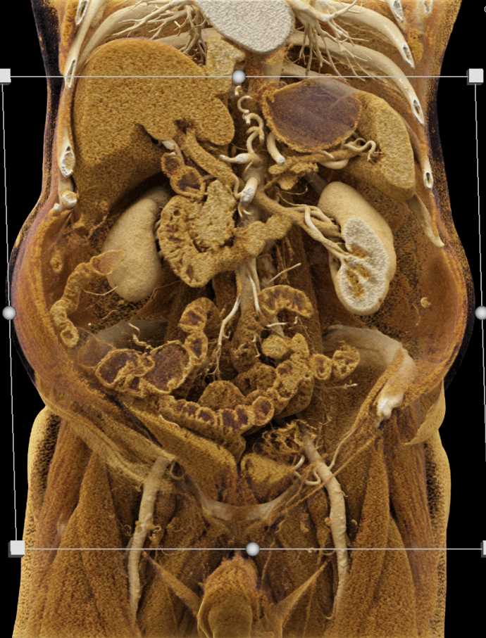 Gastric GIST Tumor - CTisus CT Scan