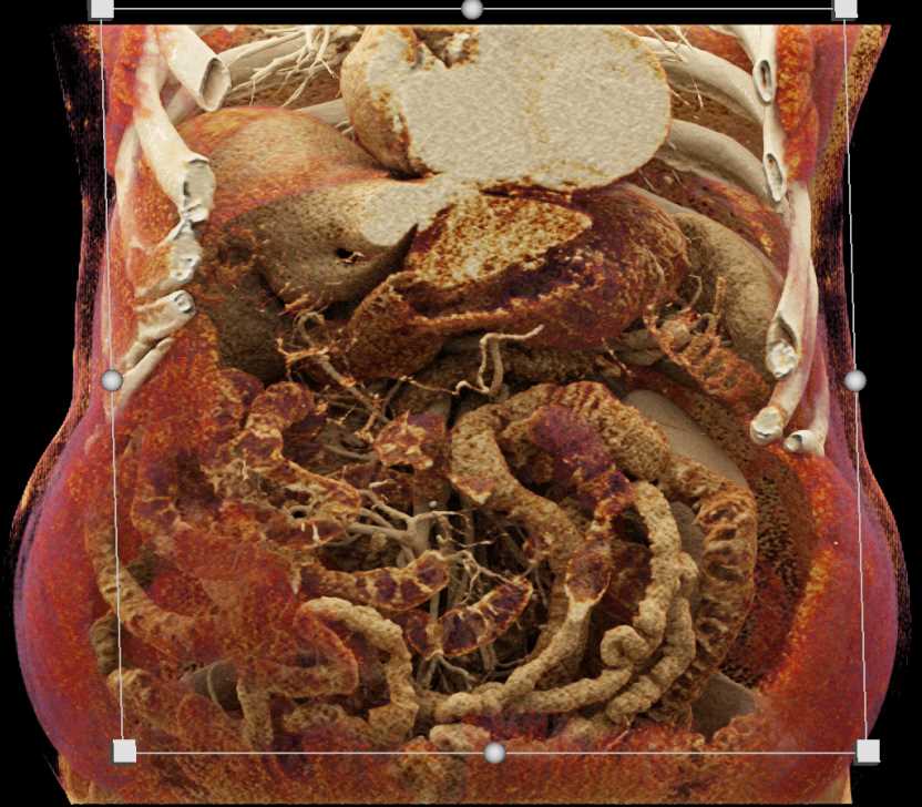 Gastric GIST Tumor - CTisus CT Scan
