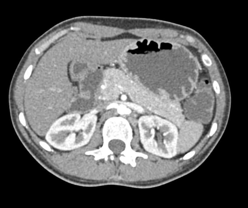 Gastritis - CTisus CT Scan