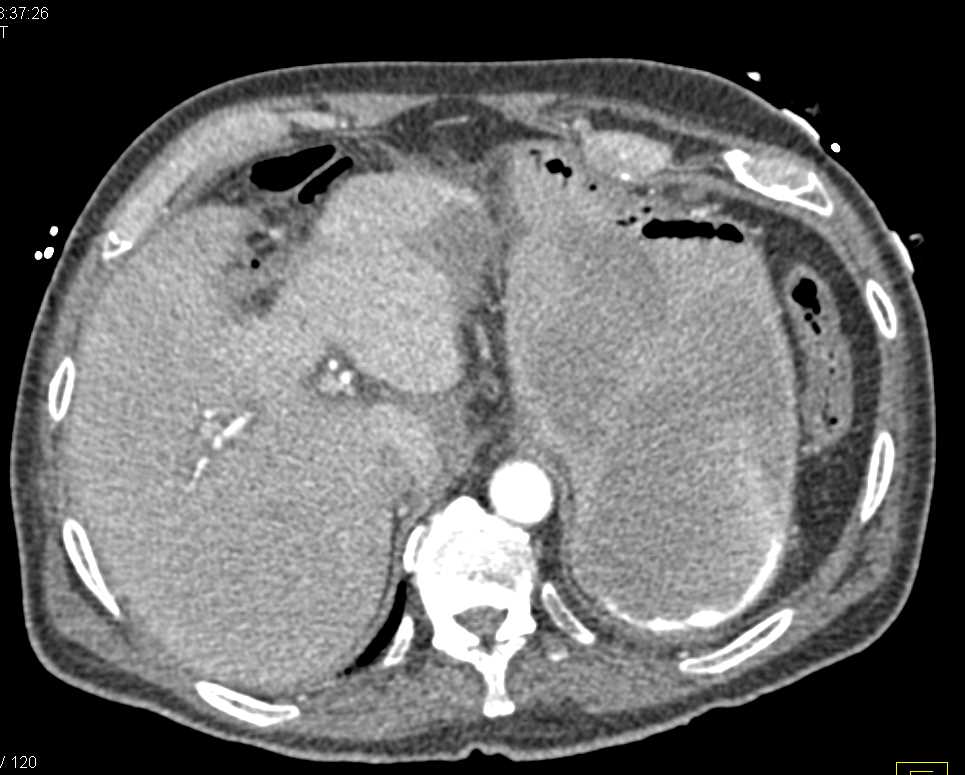 Perforated Gastric Ulcer with Bleed - CTisus CT Scan