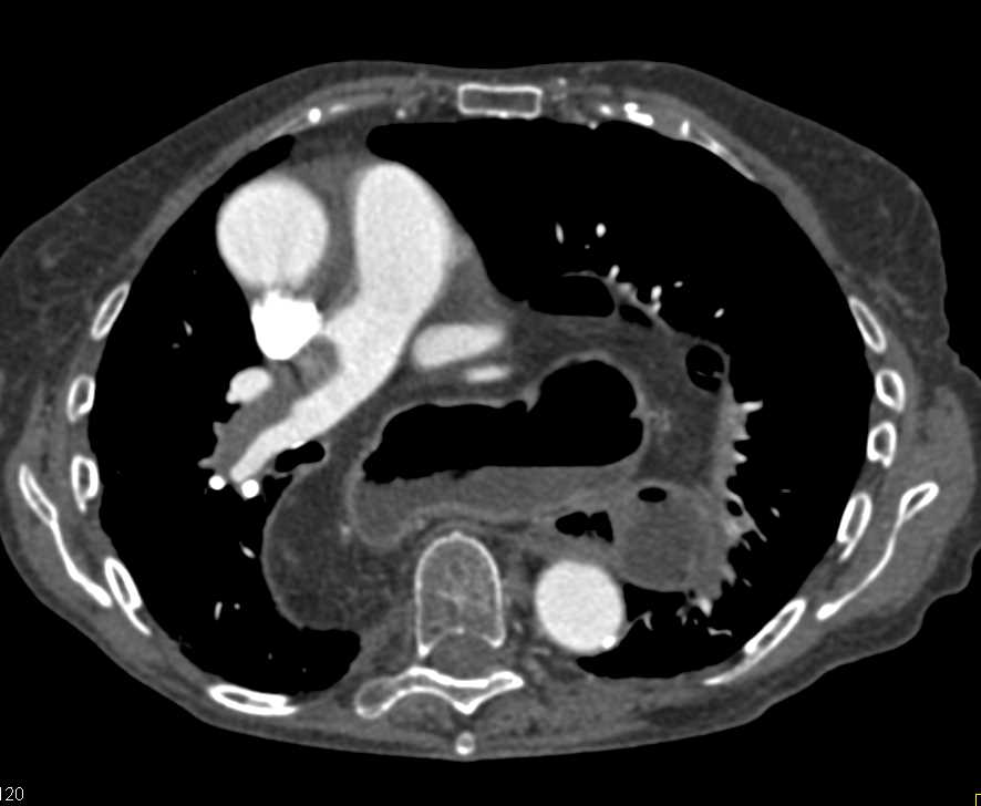 Gastric Volvulus - CTisus CT Scan