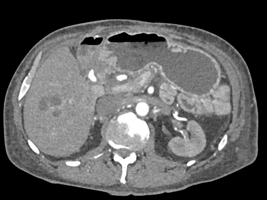 Gastric Adenocarcinoma and Liver Abscesses - CTisus CT Scan