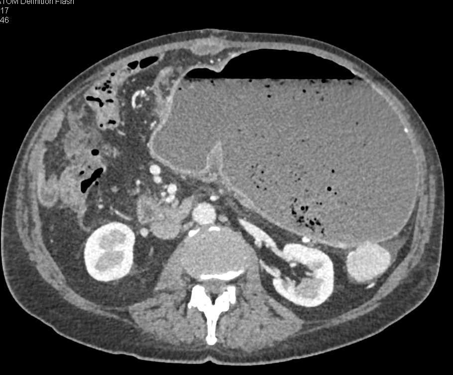Gastric Outlet Obstruction due to Infiltrating Gastric Adenocarcinoma - CTisus CT Scan