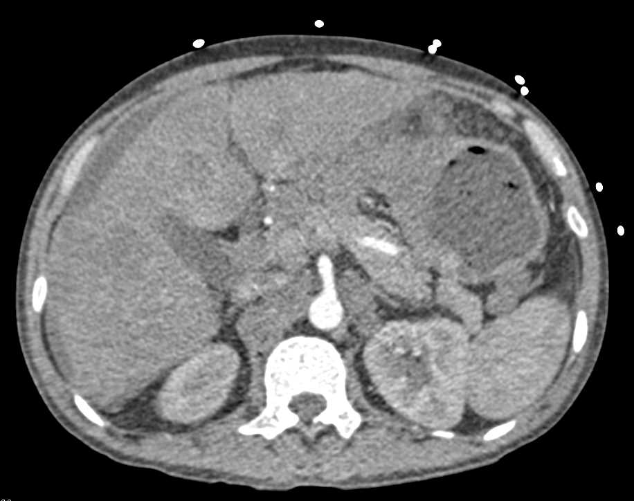 Gastric Cancer with Liver Metastases - CTisus CT Scan