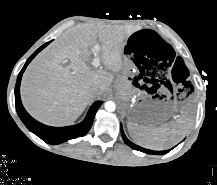 Gastric Adenocarcinoma - CTisus CT Scan