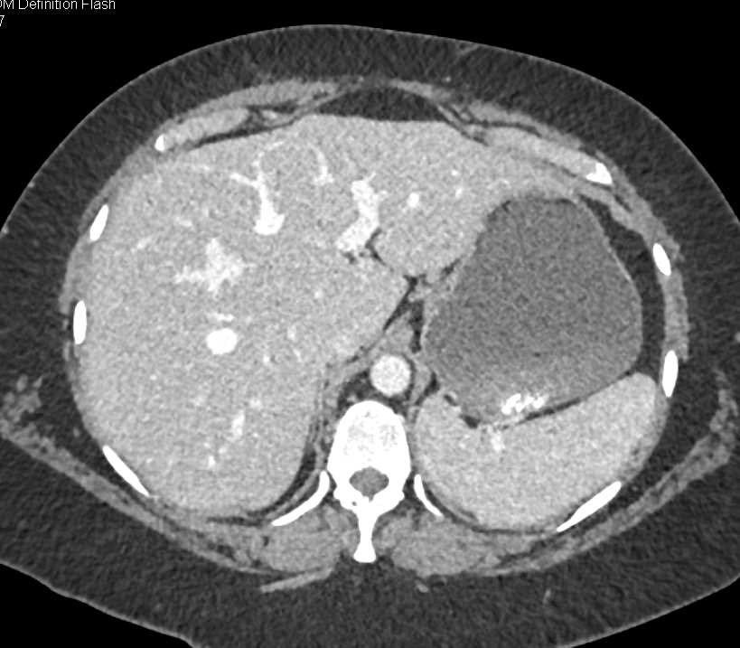 Retained Material in the Stomach Simulating Blood - CTisus CT Scan