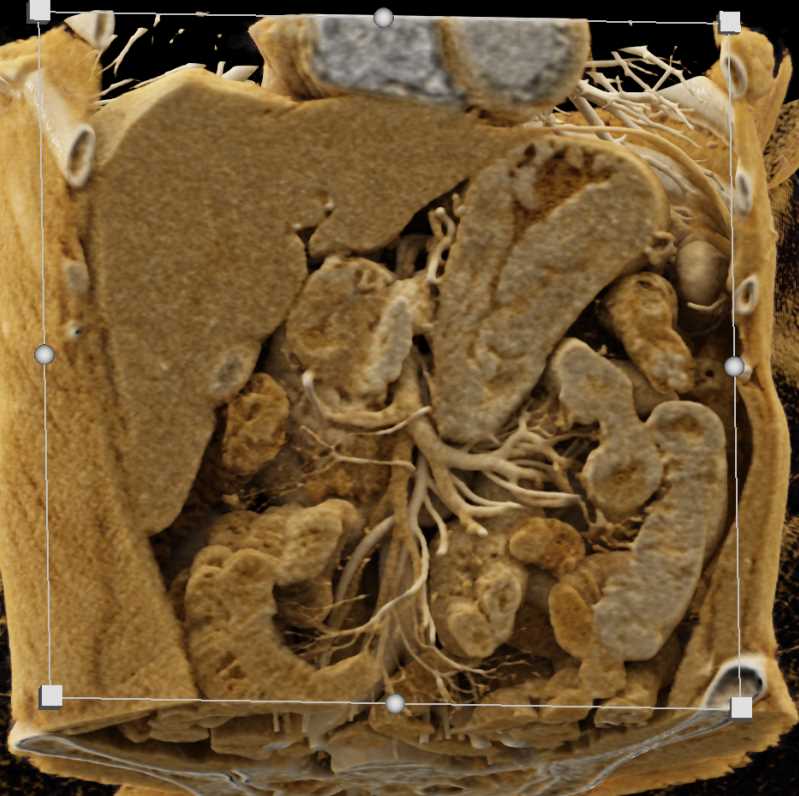 Gastric Lymphoma - CTisus CT Scan