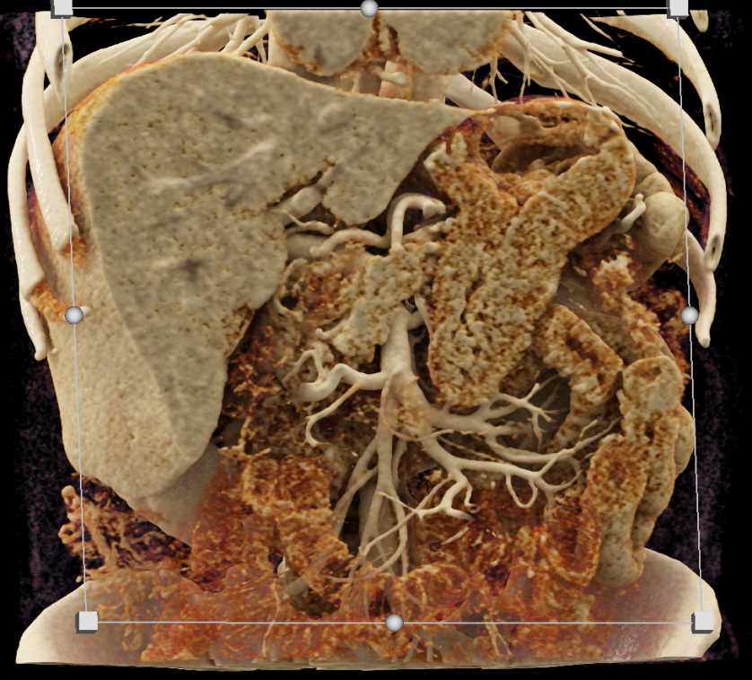 Gastric Lymphoma - CTisus CT Scan