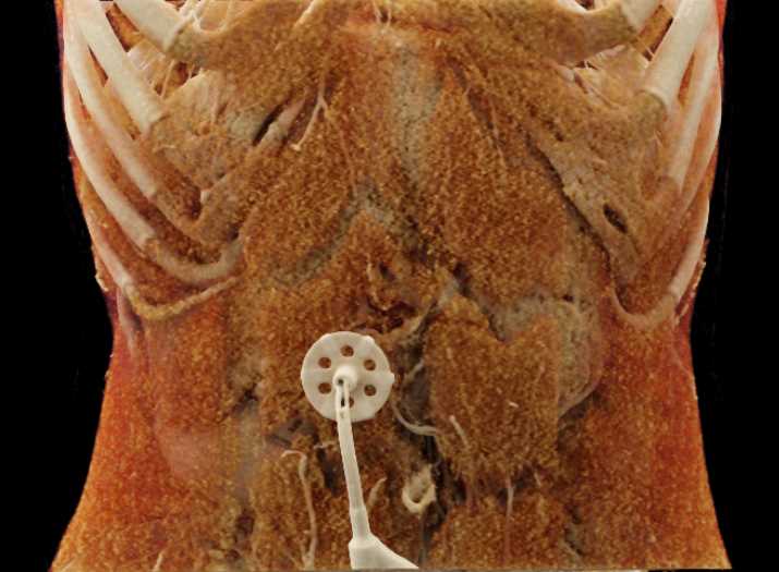 G-Tube Placement - CTisus CT Scan