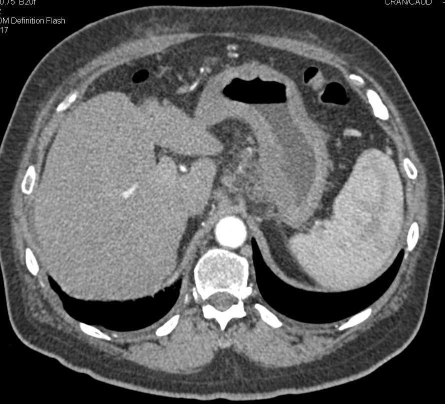 Gastric Adenocarcinoma - CTisus CT Scan