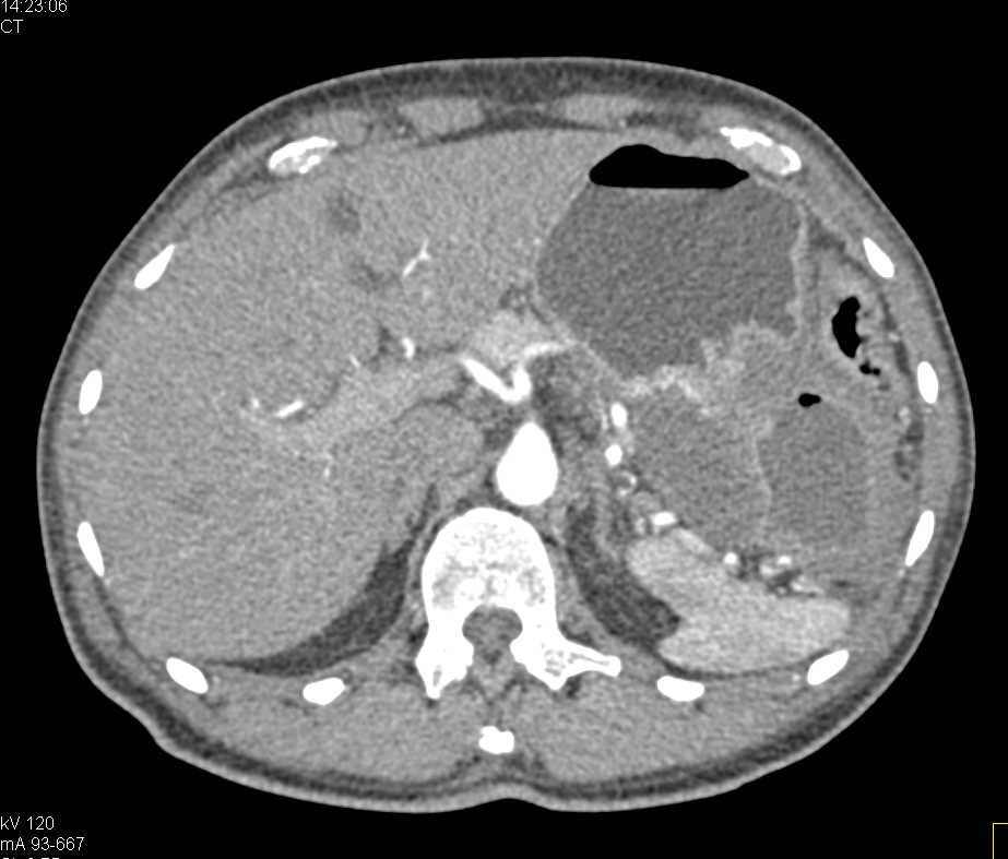 Ulcerating Gastric GIST Tumor - CTisus CT Scan