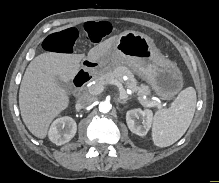 Gastric Adenocarcinoma Which is Infiltrating - CTisus CT Scan