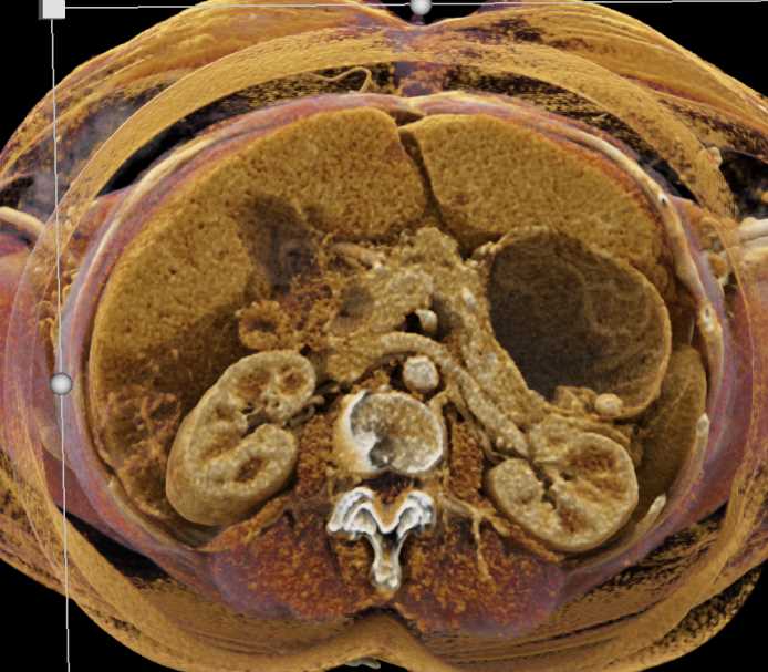 Cinematic Rendering of Gastric Polyp - CTisus CT Scan