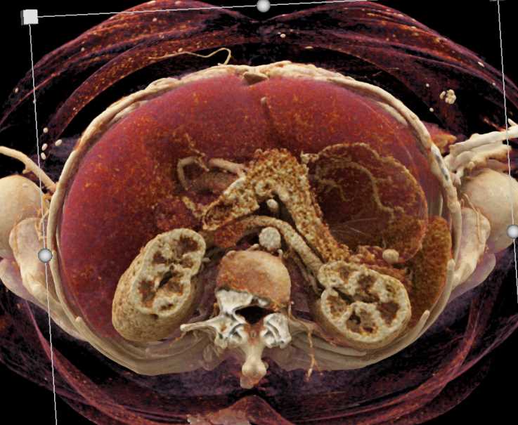 Cinematic Rendering of Gastric Polyp - CTisus CT Scan