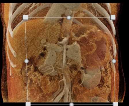 Gastric Cancer - CTisus CT Scan