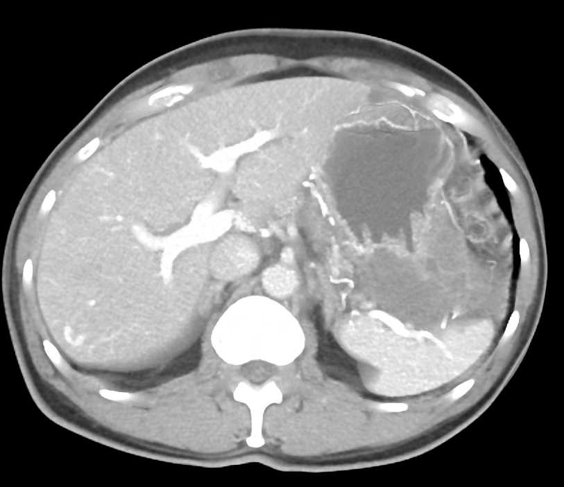 Ulcerating Gastric GIST Tumor - CTisus CT Scan