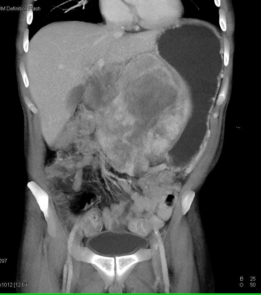 Large Gastric GIST Tumor - CTisus CT Scan