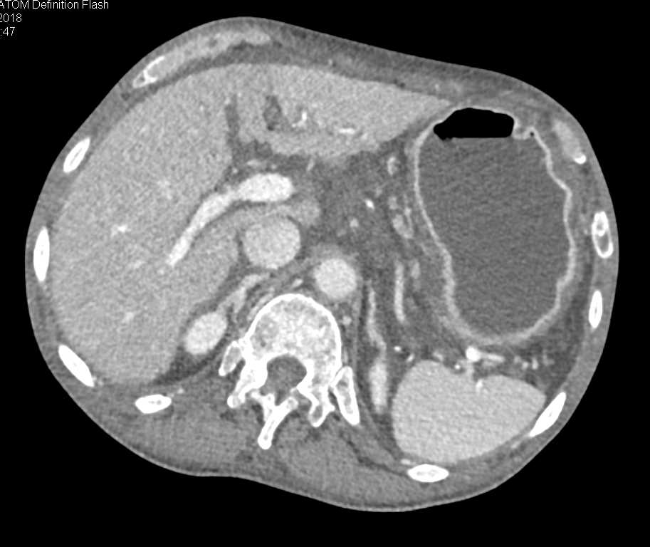Gastric Adenocarcinoma - CTisus CT Scan