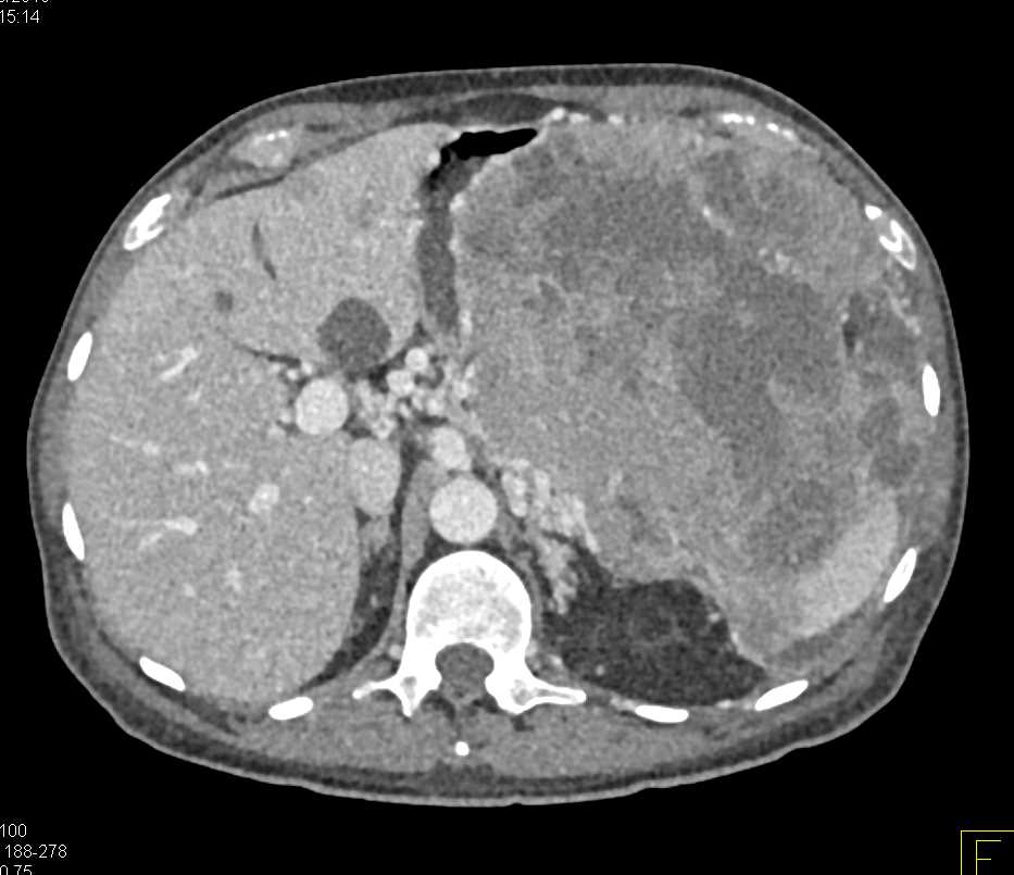 Ulcerating Gastric GIST Tumor - CTisus CT Scan
