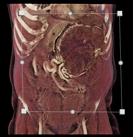 Ulcerating Gastric GIST Tumor - CTisus CT Scan