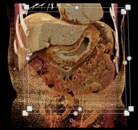 Linitis Plastica Stomach - CTisus CT Scan