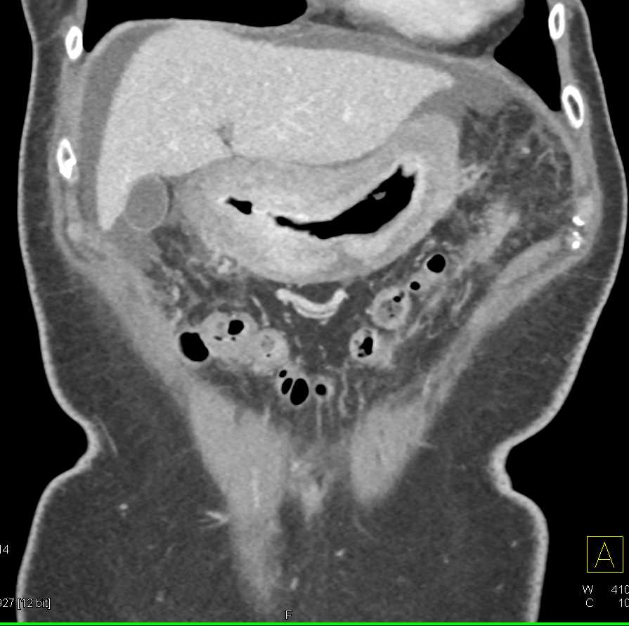 Linitis Plastica Stomach with Carcinomatosis - CTisus CT Scan