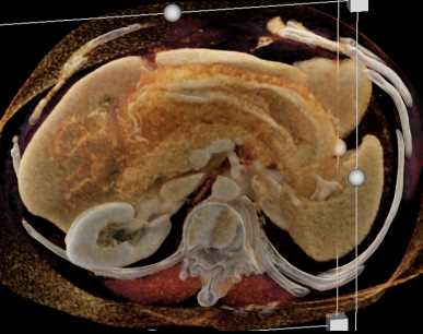 Linitis Plastica Stomach with Carcinomatosis - CTisus CT Scan