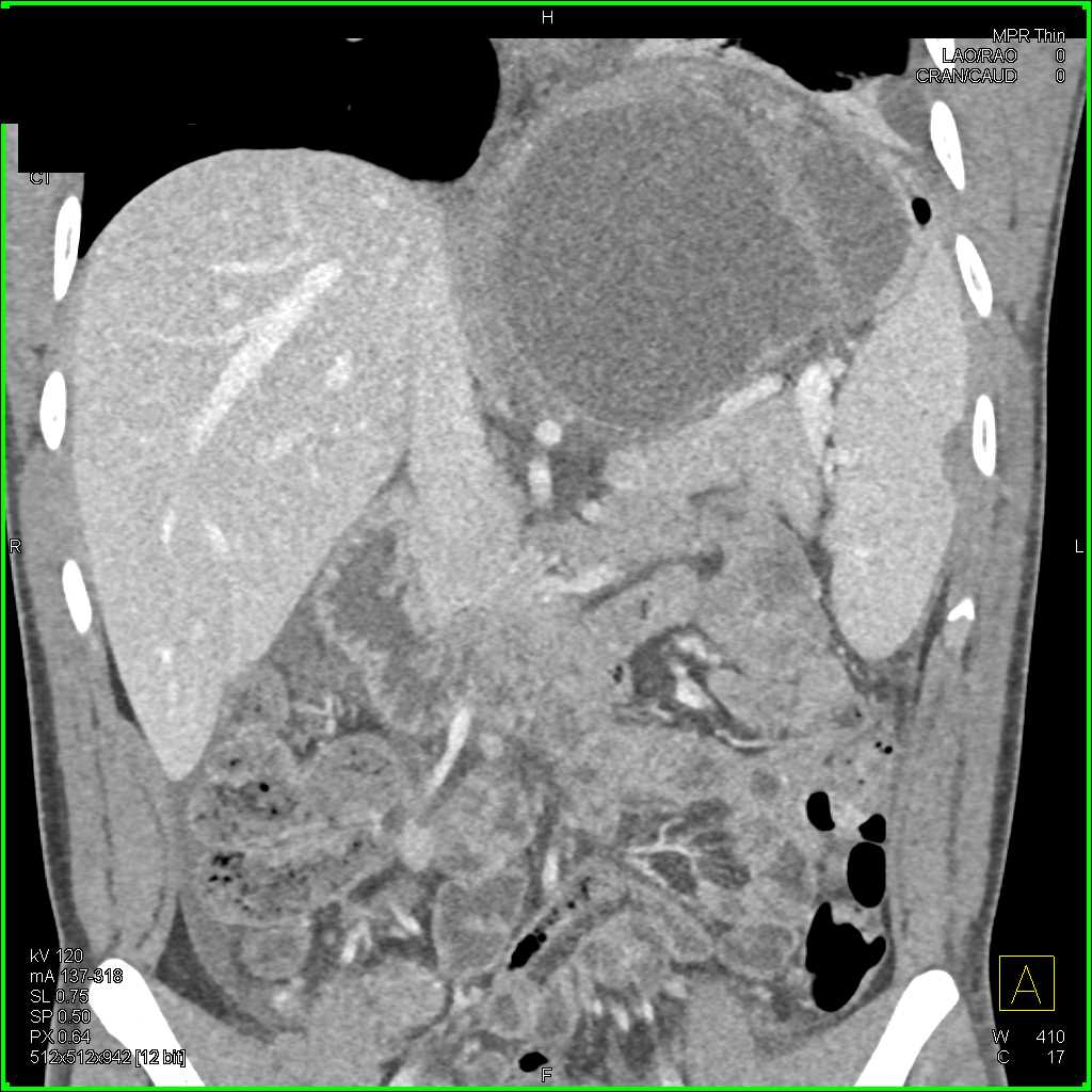 Gastric Perforation and Pneumoperitoneum - CTisus CT Scan