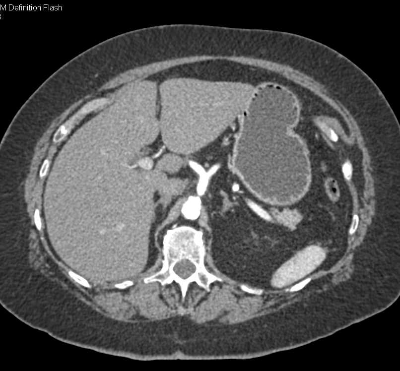 Gastric GIST with calcification - CTisus CT Scan