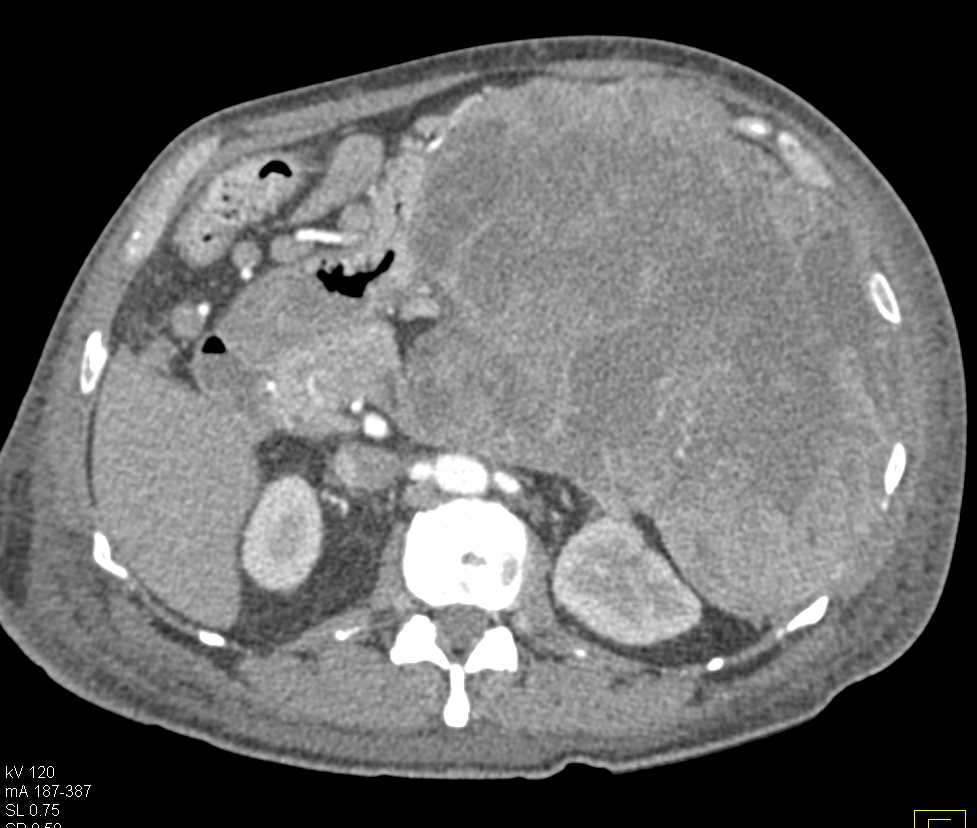 Large Gastric GIST Tumor - CTisus CT Scan