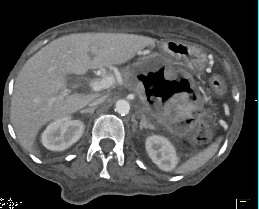 Ulcerating Gastric Adenocarcinoma - CTisus CT Scan