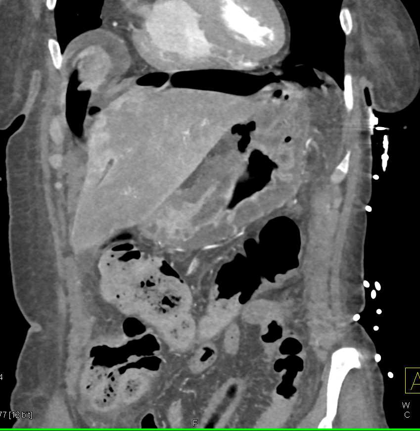 Gastric Cancer with Perforating Ulcer - CTisus CT Scan