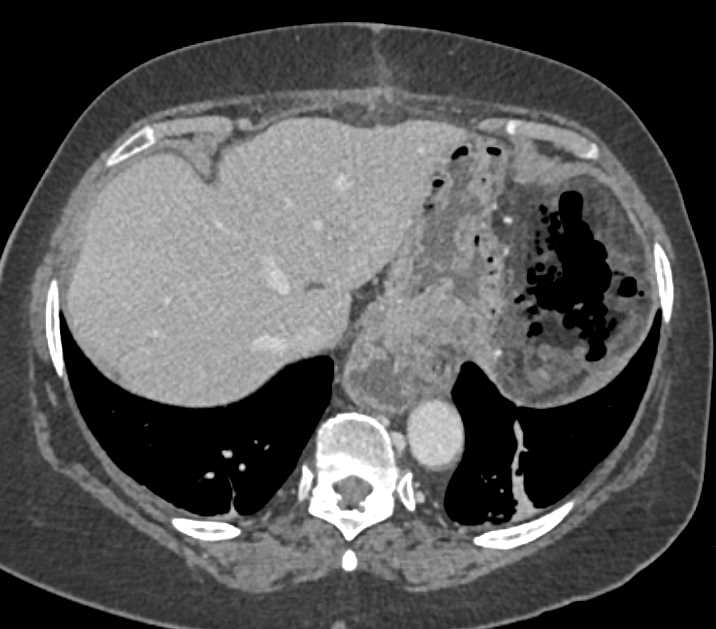 LUQ Abscess due to Gastric Perforation - CTisus CT Scan