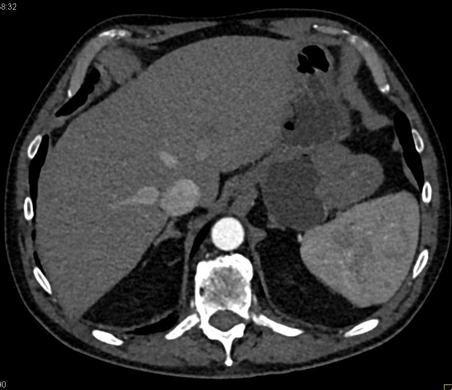Gastric GIST Tumor - CTisus CT Scan