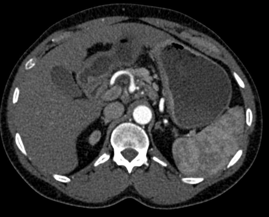 Polypoid Lesion in the Stomach was a Carcinoid - CTisus CT Scan