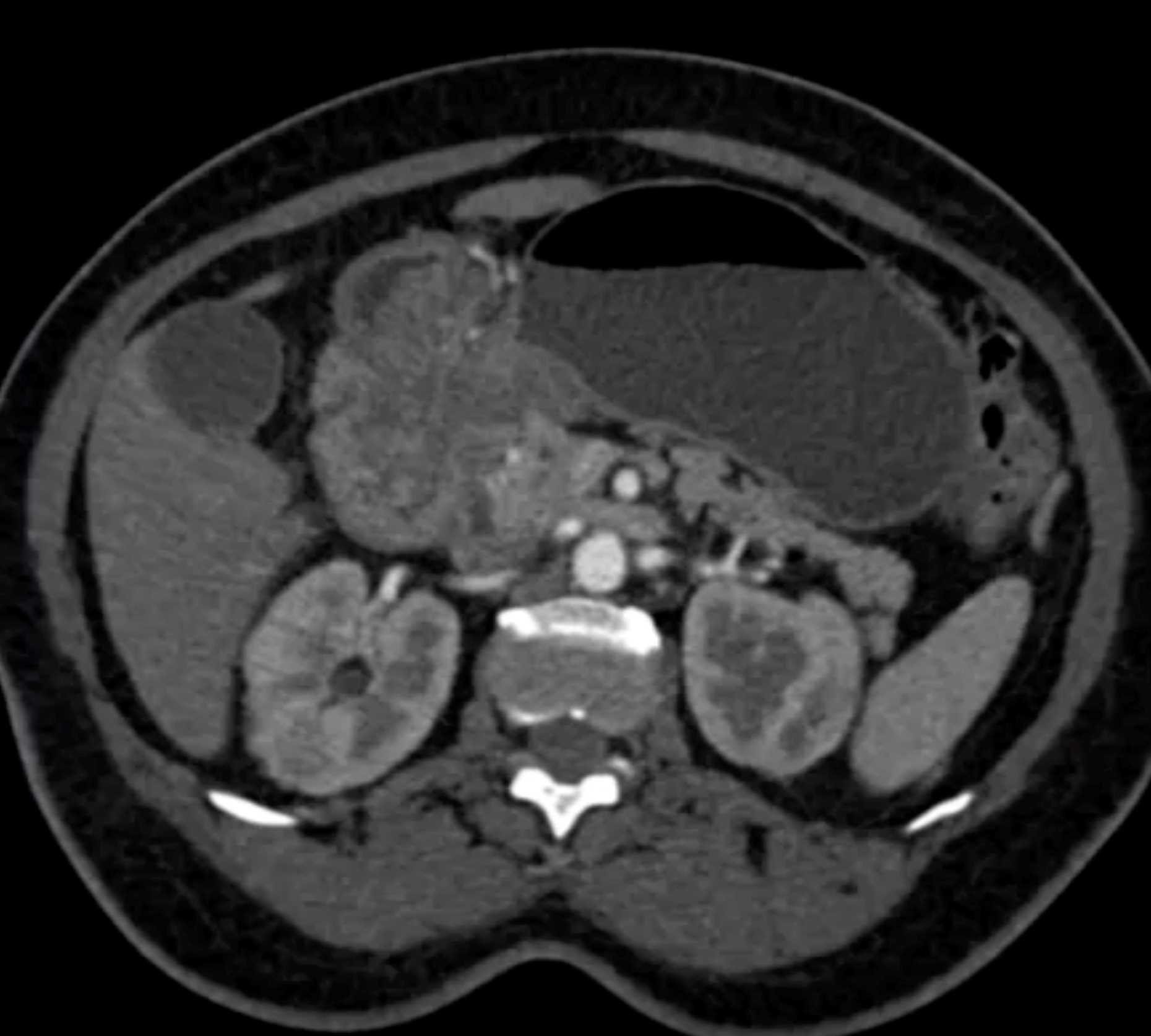 Lobular Capillary Hemangioma of the Stomach - CTisus CT Scan