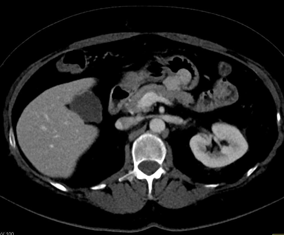 Bilobated Gastric GIST Tumor - CTisus CT Scan