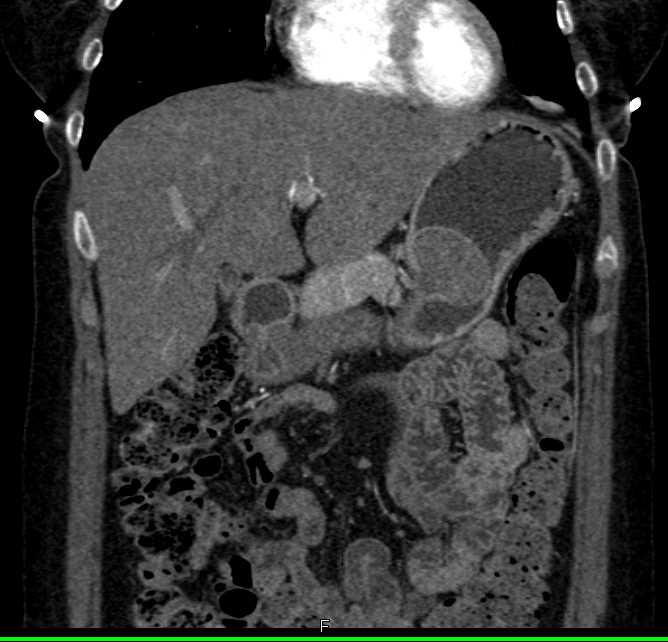 Gastric GIST Tumor - CTisus CT Scan