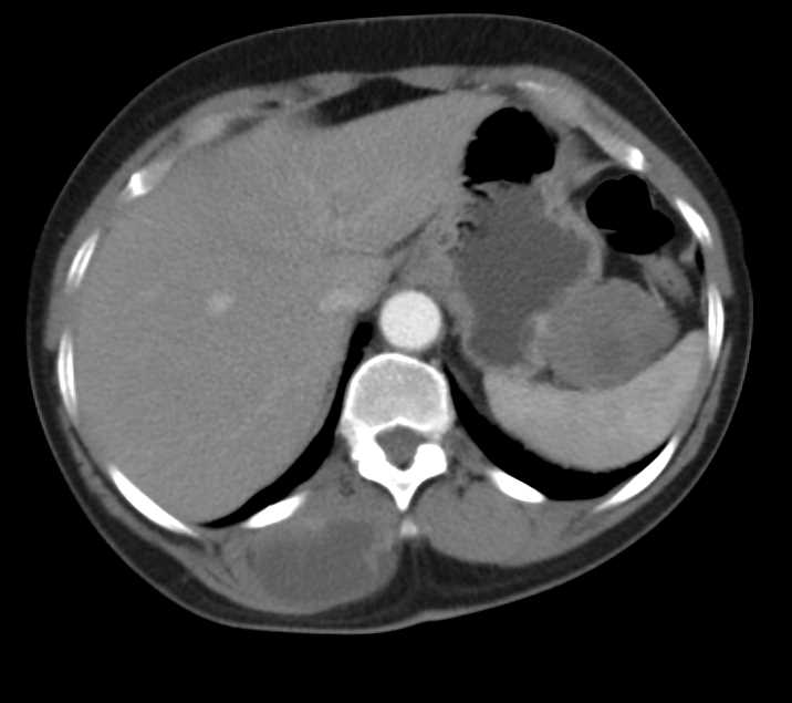 Gastric GIST Tumor - CTisus CT Scan