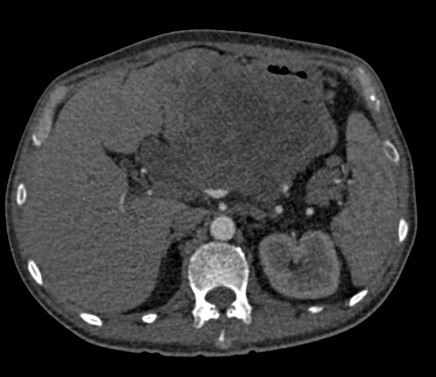 CTisus CT Scanning | Gastric Mass was GIST Tumor