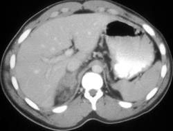 Right Adrenal Hematoma - CTisus CT Scan