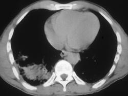 Lung Contusion With Pneumothorax - CTisus CT Scan